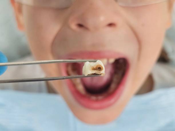 Best Emergency Dental Extractions in Dothan, AL